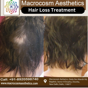 Get your confidence back by hair loss treatment with Macrocosm Aesthetics.