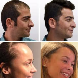 Hair transplant in man and woman
