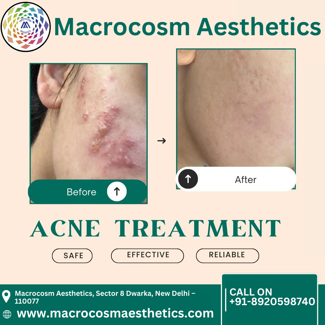 Best Clinic for Acne Scars Treatment in Dwarka, Delhi
