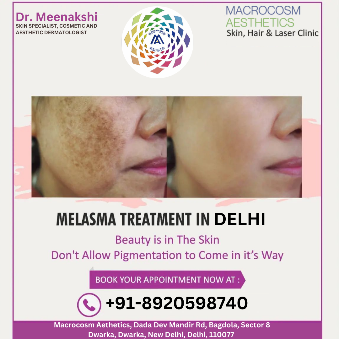Best clinic for Melasma treatment in Dwarka, Delhi.
