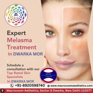 Expert Melasma Treatment in Dwarka, Mor