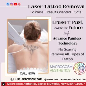 Painless Tattoo removal with Laser treatment