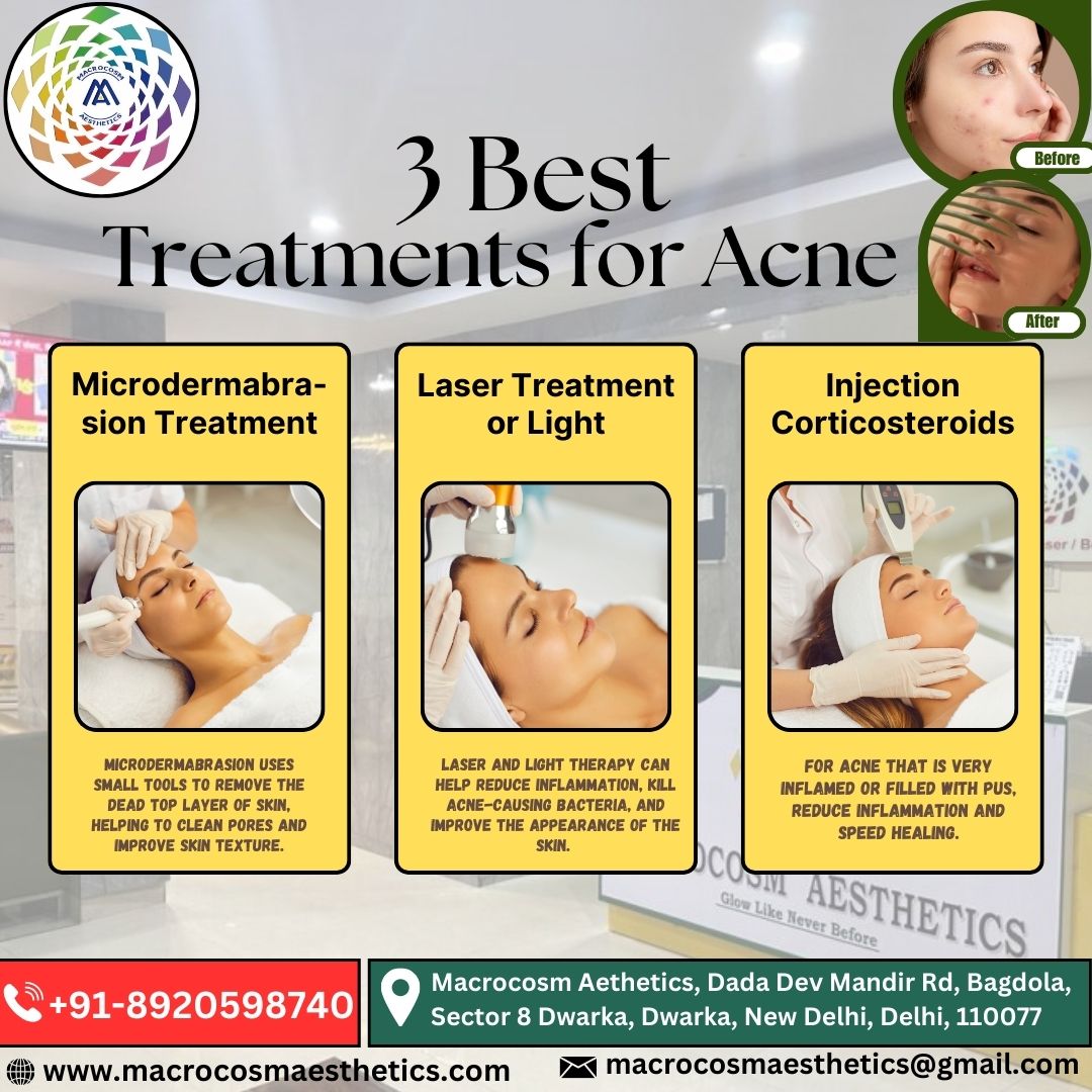 3 Best Treatments for Acne