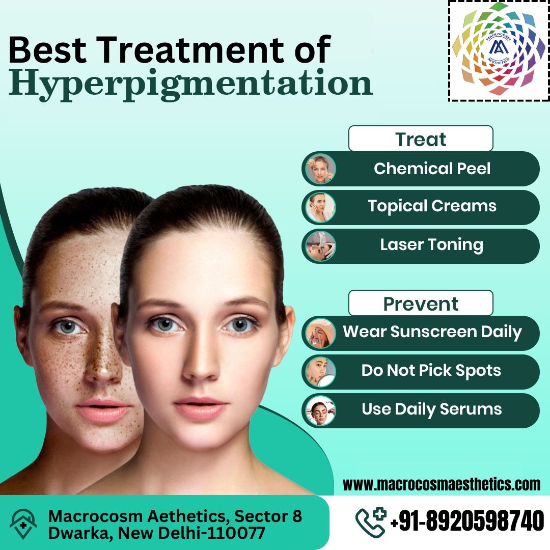 Best Treatment of Hyperpigmentation in Dwarka, Delhi.