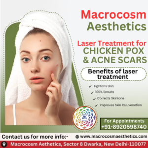 Laser treatment for Chicken Pox and Acne Scars 